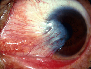 Pterygium_(from_Michigan_Uni_site,_CC-BY)